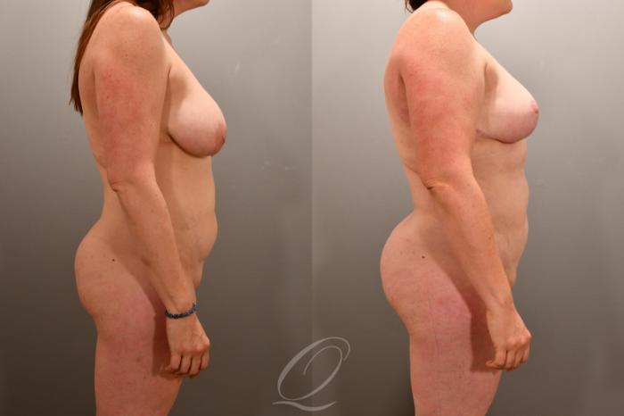 Liposuction Case 1001865 Before & After Right Side | Serving Rochester, Syracuse & Buffalo, NY | Quatela Center for Plastic Surgery