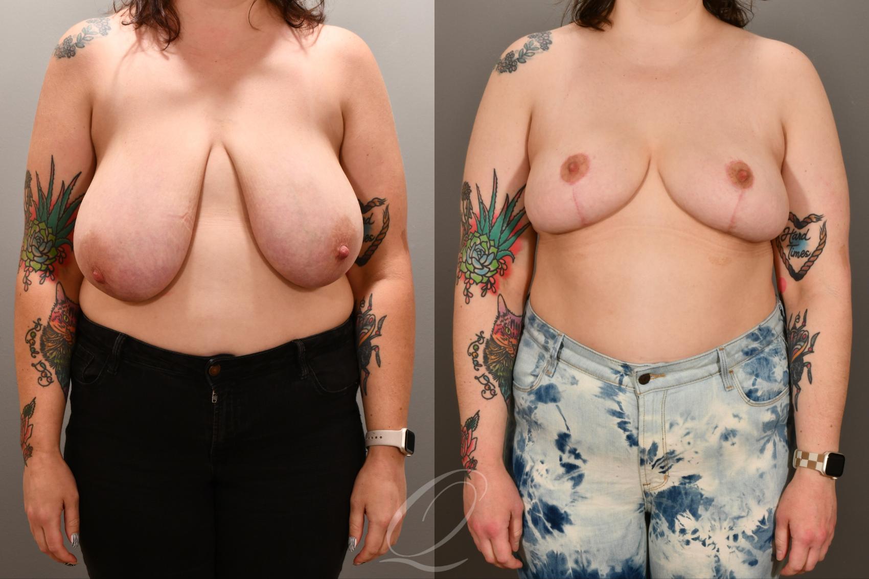 Breast Lift Case 1001893 Before & After Front | Serving Rochester, Syracuse & Buffalo, NY | Quatela Center for Plastic Surgery