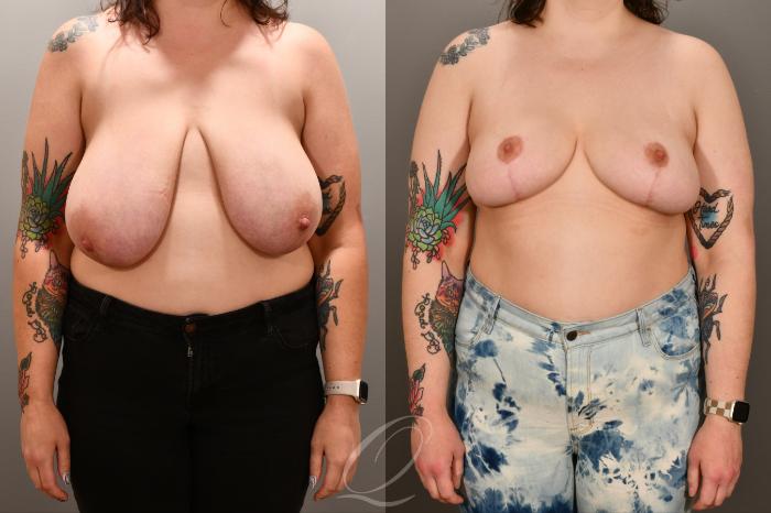 Breast Lift Case 1001893 Before & After Front | Serving Rochester, Syracuse & Buffalo, NY | Quatela Center for Plastic Surgery