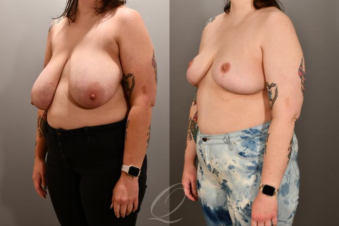 Breast Lift Case 1001893 Before & After Left Oblique | Serving Rochester, Syracuse & Buffalo, NY | Quatela Center for Plastic Surgery