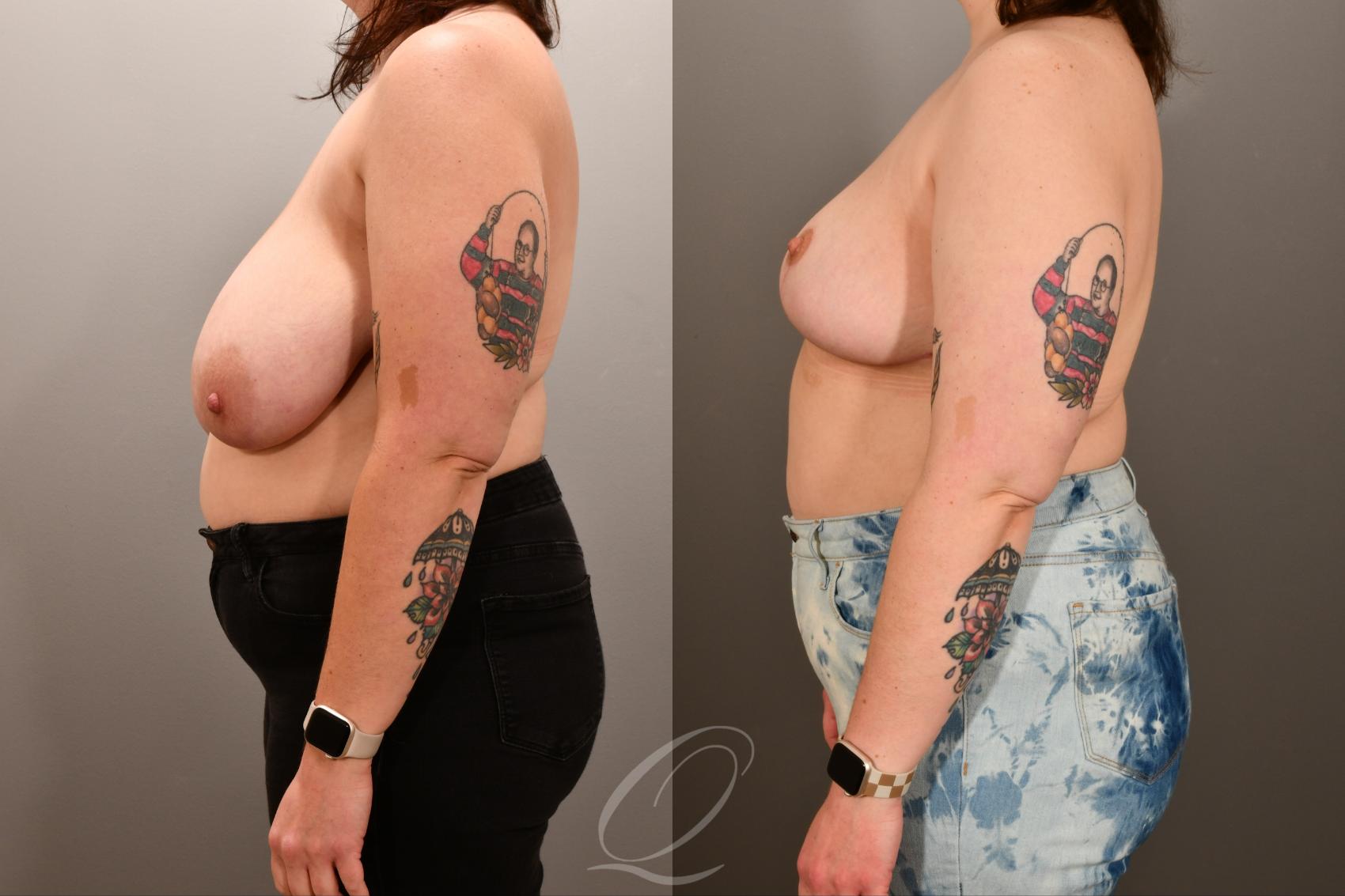 Breast Lift Case 1001893 Before & After Left Side | Serving Rochester, Syracuse & Buffalo, NY | Quatela Center for Plastic Surgery