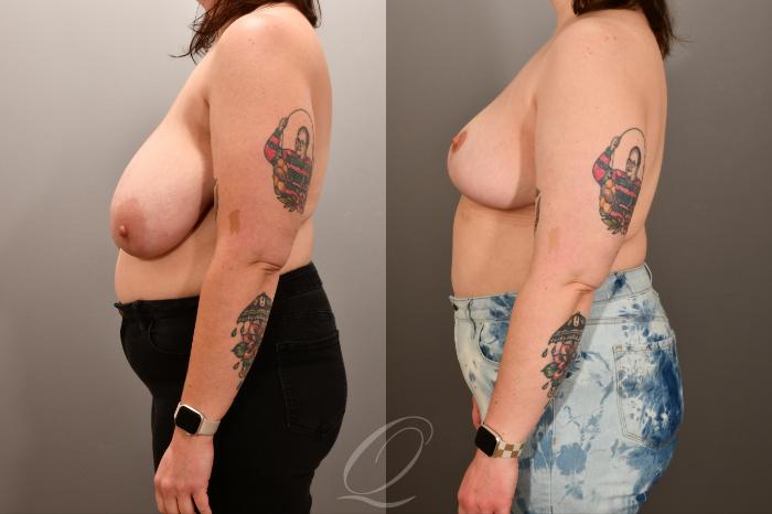 Breast Lift Case 1001893 Before & After Left Side | Serving Rochester, Syracuse & Buffalo, NY | Quatela Center for Plastic Surgery