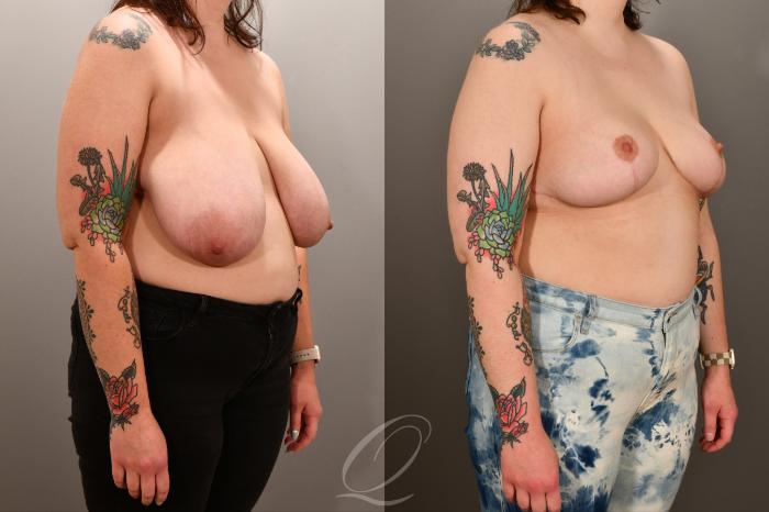 Breast Lift Case 1001893 Before & After Right Oblique | Serving Rochester, Syracuse & Buffalo, NY | Quatela Center for Plastic Surgery