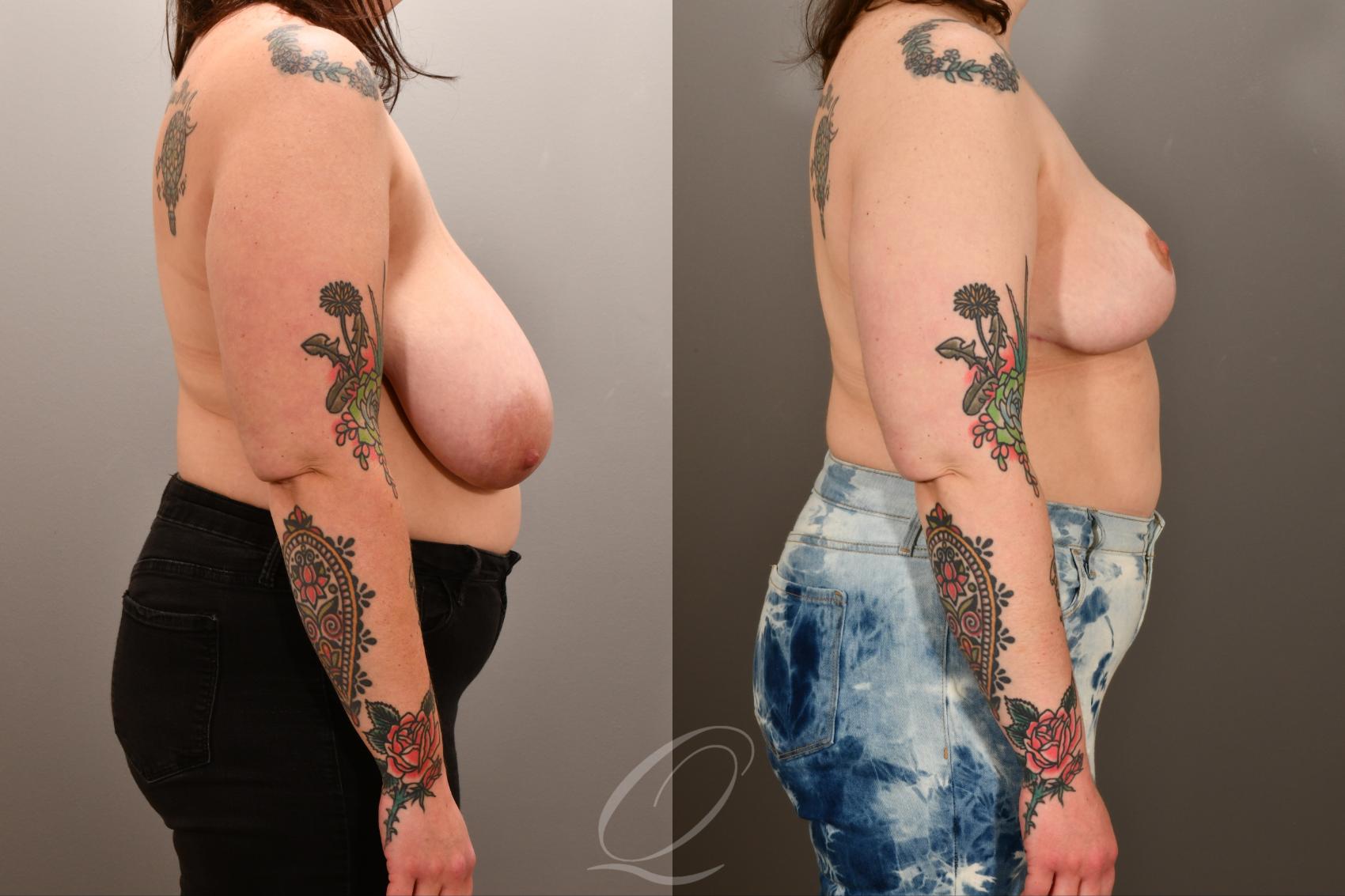 Breast Lift Case 1001893 Before & After Right Side | Serving Rochester, Syracuse & Buffalo, NY | Quatela Center for Plastic Surgery