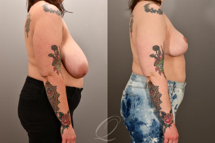 Breast Lift Case 1001893 Before & After Right Side | Serving Rochester, Syracuse & Buffalo, NY | Quatela Center for Plastic Surgery