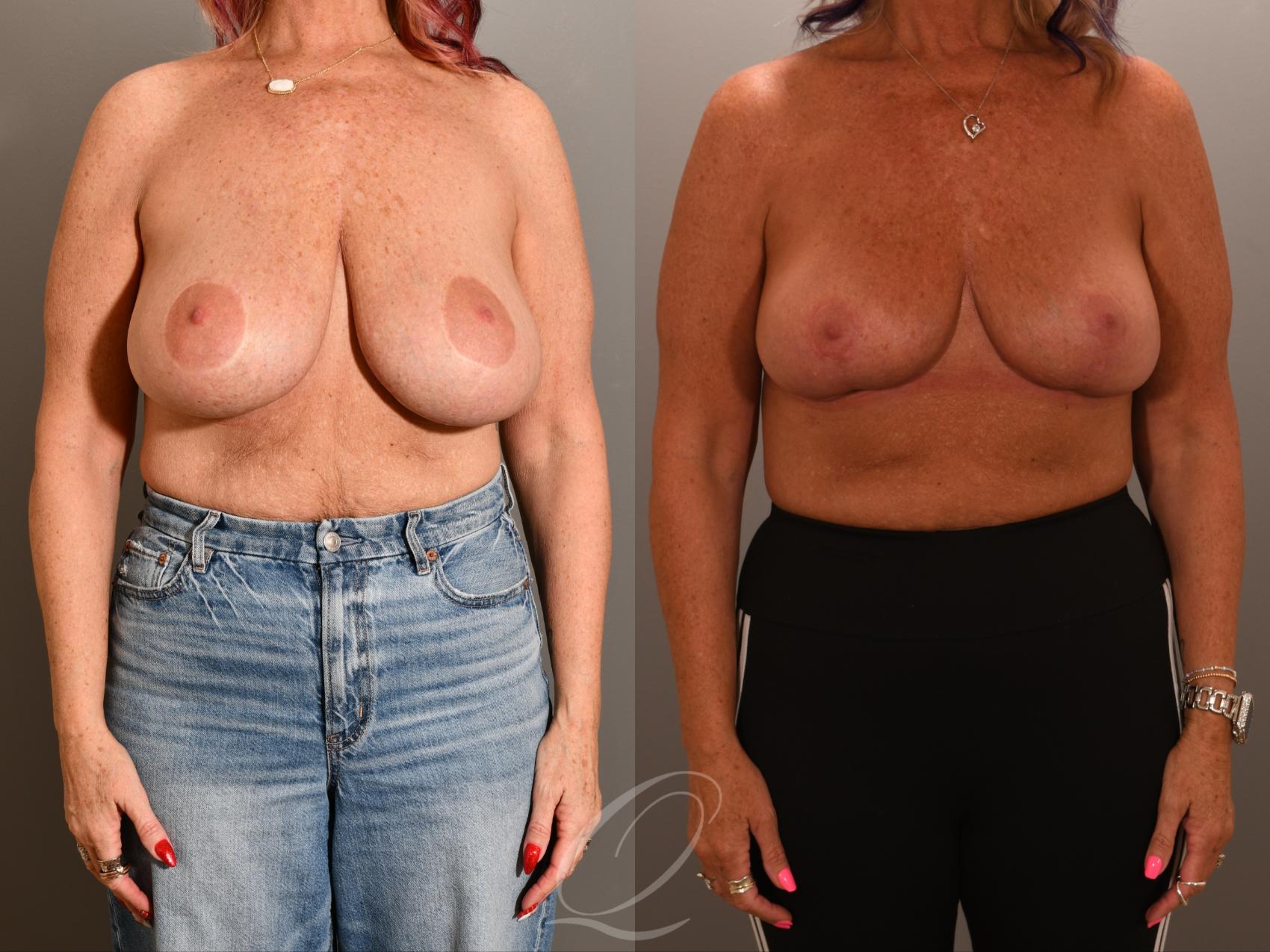 Breast Lift Case 1001903 Before & After Front | Serving Rochester, Syracuse & Buffalo, NY | Quatela Center for Plastic Surgery