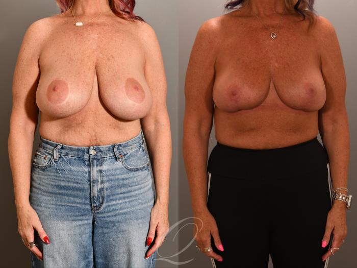 Breast Lift Case 1001903 Before & After Front | Serving Rochester, Syracuse & Buffalo, NY | Quatela Center for Plastic Surgery