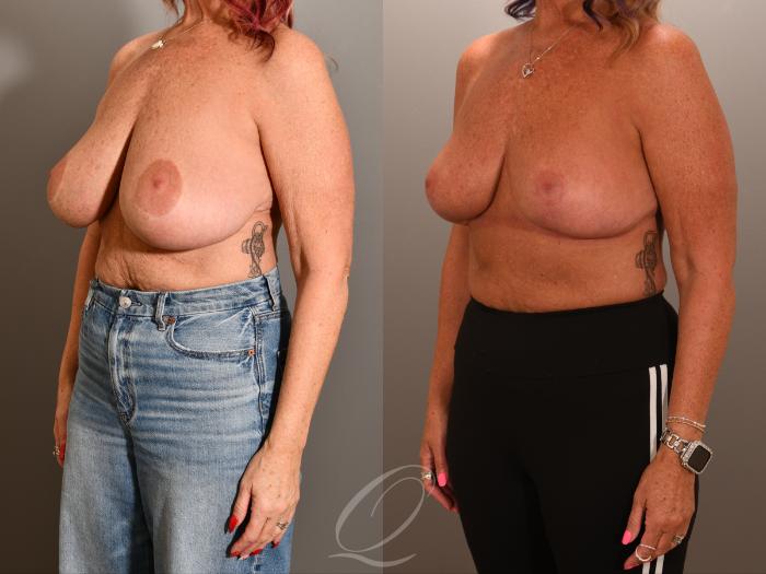 Breast Lift Case 1001903 Before & After Left Oblique | Serving Rochester, Syracuse & Buffalo, NY | Quatela Center for Plastic Surgery