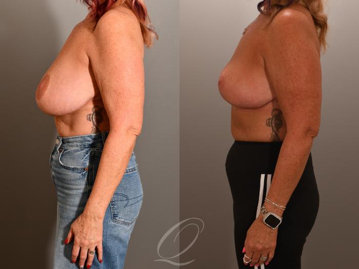 Breast Lift Case 1001903 Before & After Left Side | Serving Rochester, Syracuse & Buffalo, NY | Quatela Center for Plastic Surgery