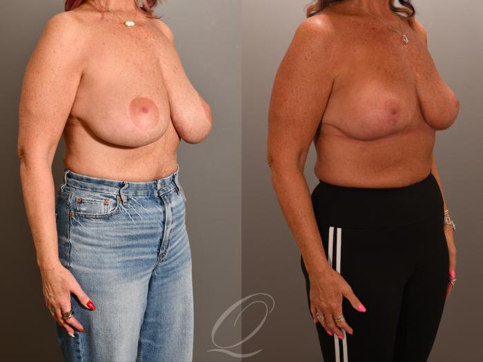 Breast Lift Case 1001903 Before & After Right Oblique | Serving Rochester, Syracuse & Buffalo, NY | Quatela Center for Plastic Surgery