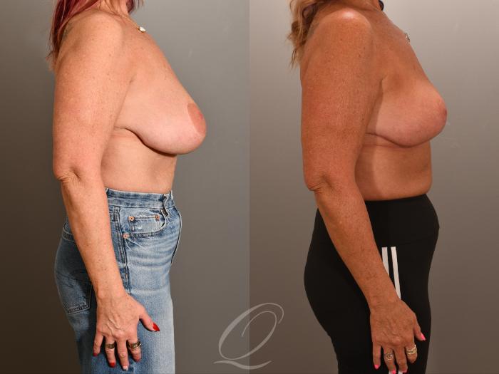 Breast Lift Case 1001903 Before & After Right Side | Serving Rochester, Syracuse & Buffalo, NY | Quatela Center for Plastic Surgery