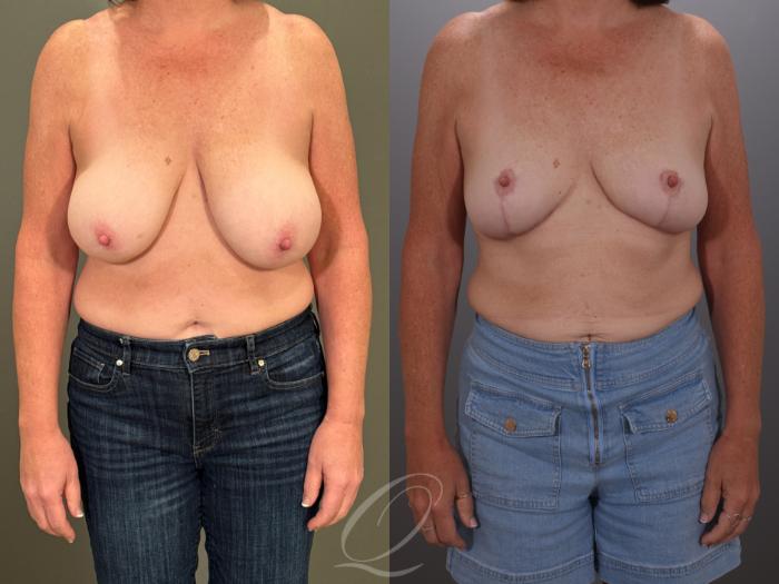 Breast Lift Case 1001907 Before & After Front | Serving Rochester, Syracuse & Buffalo, NY | Quatela Center for Plastic Surgery