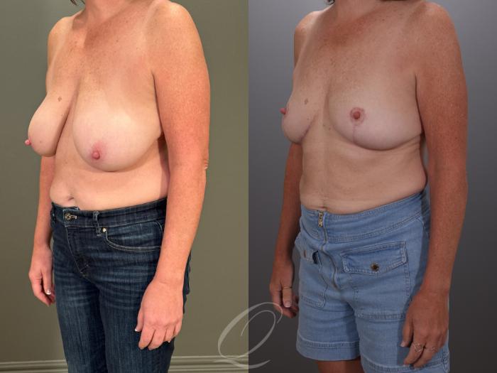 Breast Lift Case 1001907 Before & After Left Oblique | Serving Rochester, Syracuse & Buffalo, NY | Quatela Center for Plastic Surgery