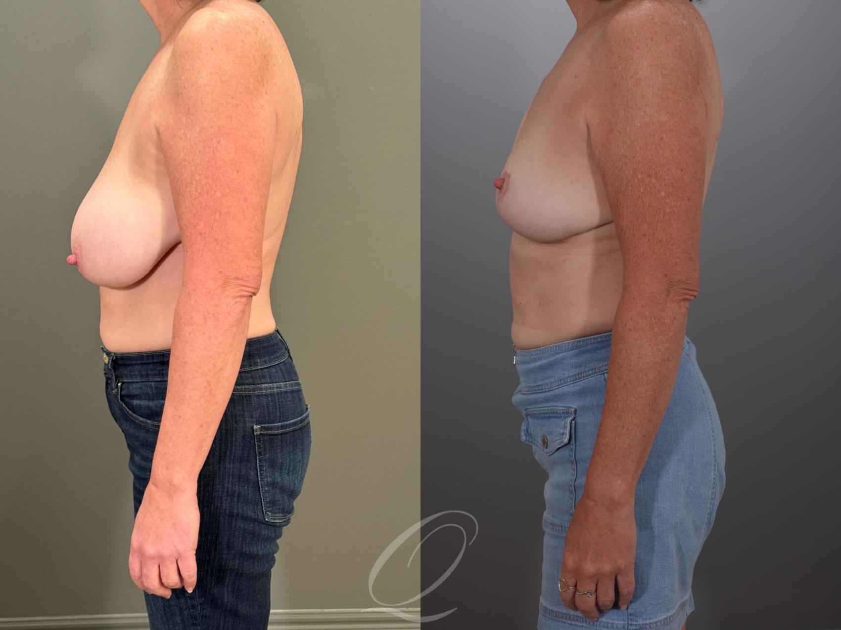 Breast Lift Case 1001907 Before & After Left Side | Serving Rochester, Syracuse & Buffalo, NY | Quatela Center for Plastic Surgery