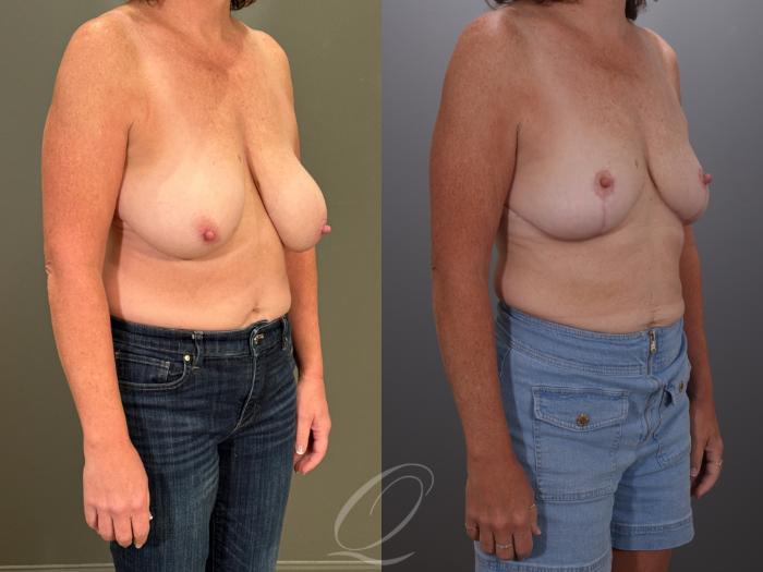 Breast Lift Case 1001907 Before & After Right Oblique | Serving Rochester, Syracuse & Buffalo, NY | Quatela Center for Plastic Surgery