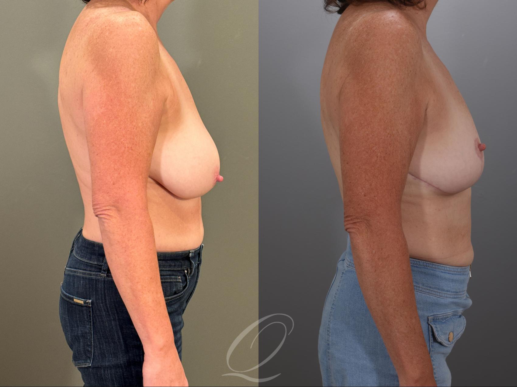 Breast Lift Case 1001907 Before & After Right Side | Serving Rochester, Syracuse & Buffalo, NY | Quatela Center for Plastic Surgery