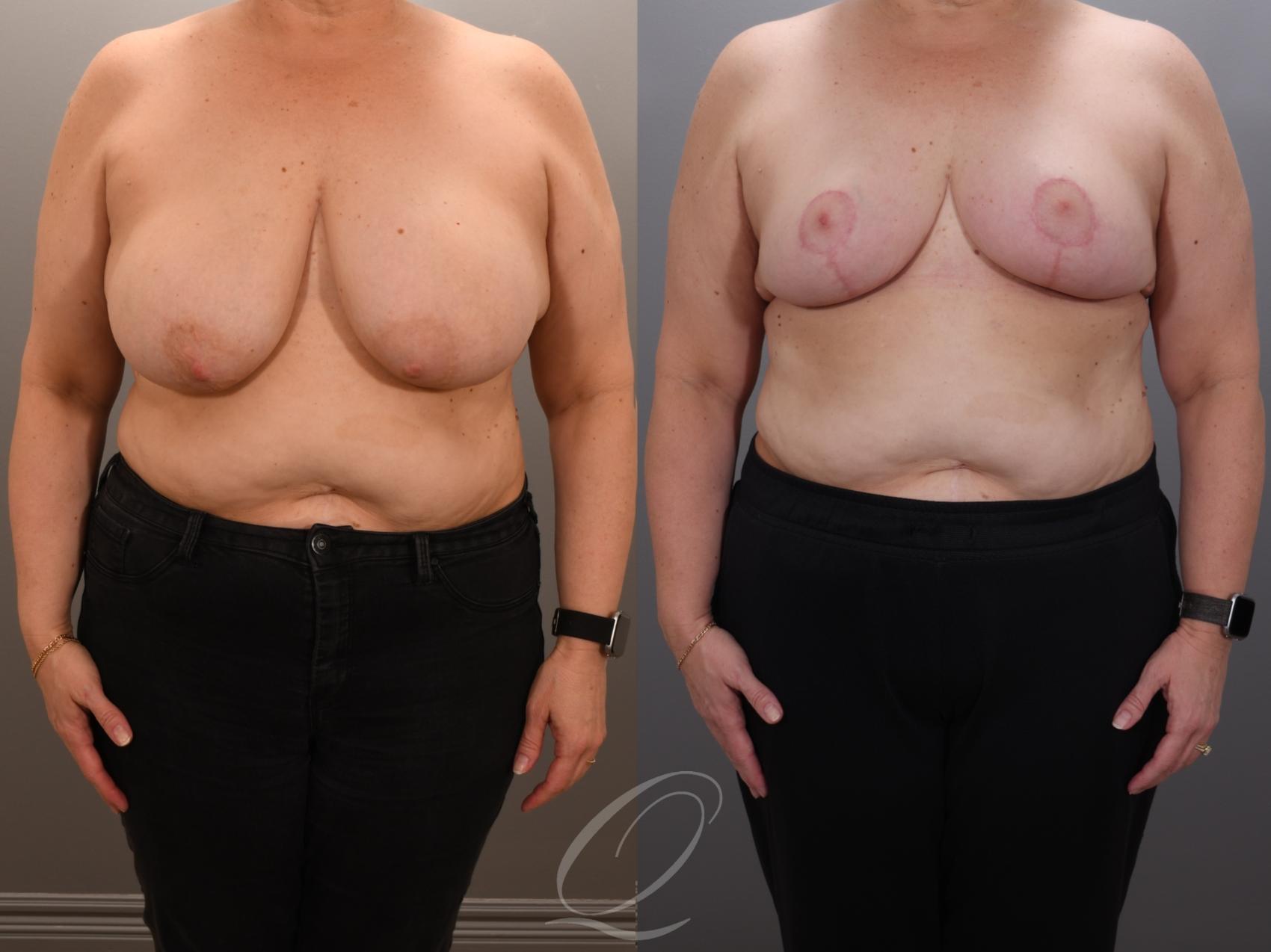 Breast Lift Case 1001919 Before & After Front | Serving Rochester, Syracuse & Buffalo, NY | Quatela Center for Plastic Surgery