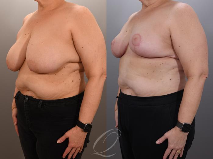 Breast Lift Case 1001919 Before & After Left Oblique | Serving Rochester, Syracuse & Buffalo, NY | Quatela Center for Plastic Surgery