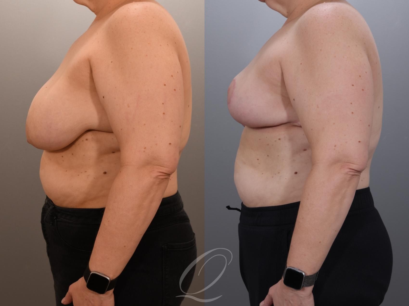 Breast Lift Case 1001919 Before & After Left Side | Serving Rochester, Syracuse & Buffalo, NY | Quatela Center for Plastic Surgery