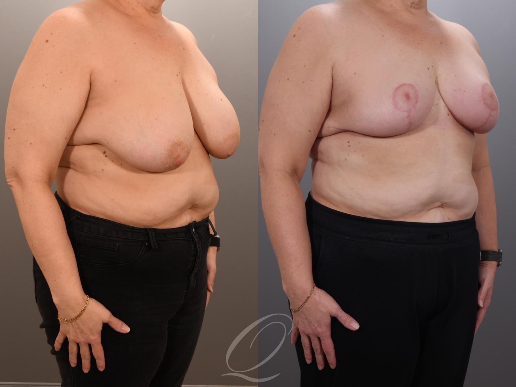 Breast Lift Case 1001919 Before & After Right Oblique | Serving Rochester, Syracuse & Buffalo, NY | Quatela Center for Plastic Surgery