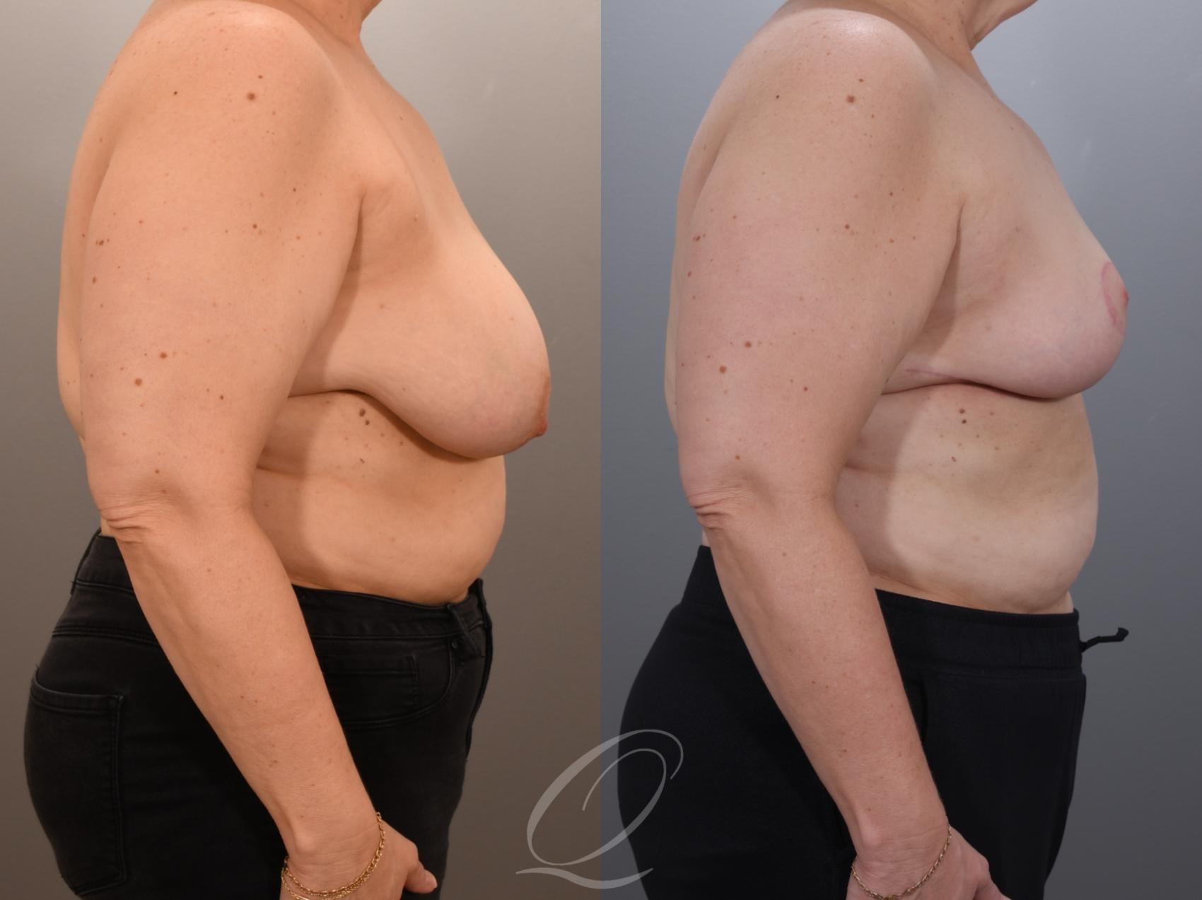 Breast Lift Case 1001919 Before & After Right Side | Serving Rochester, Syracuse & Buffalo, NY | Quatela Center for Plastic Surgery