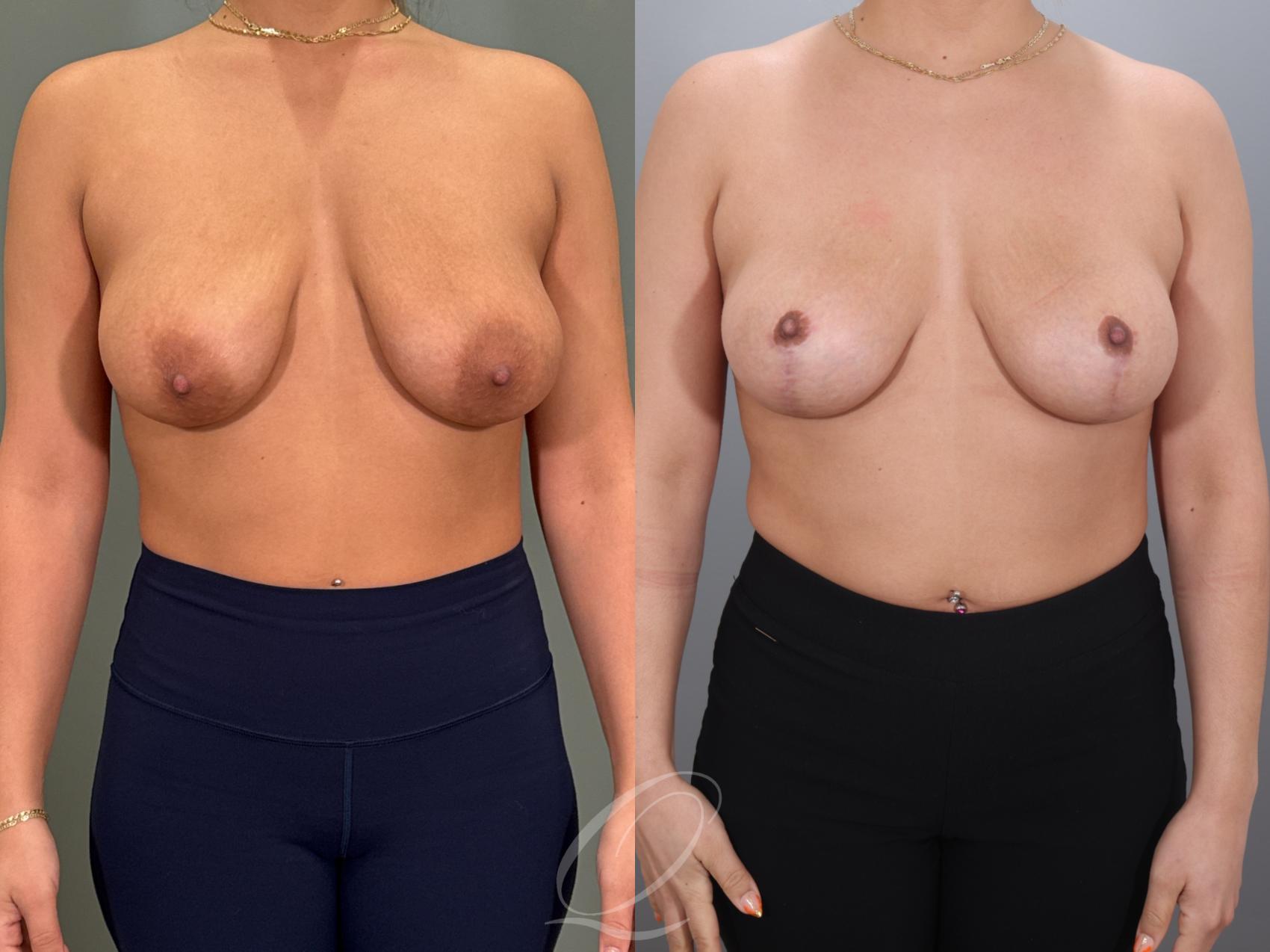 Breast Lift Case 1001980 Before & After Front | Serving Rochester, Syracuse & Buffalo, NY | Quatela Center for Plastic Surgery