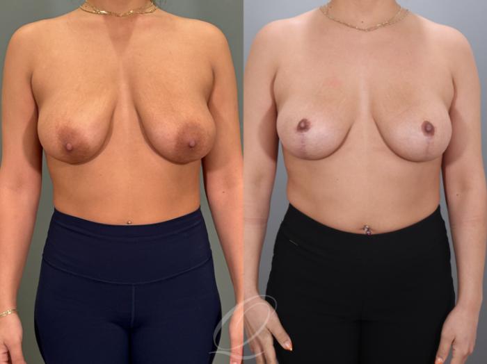 Breast Lift Case 1001980 Before & After Front | Serving Rochester, Syracuse & Buffalo, NY | Quatela Center for Plastic Surgery