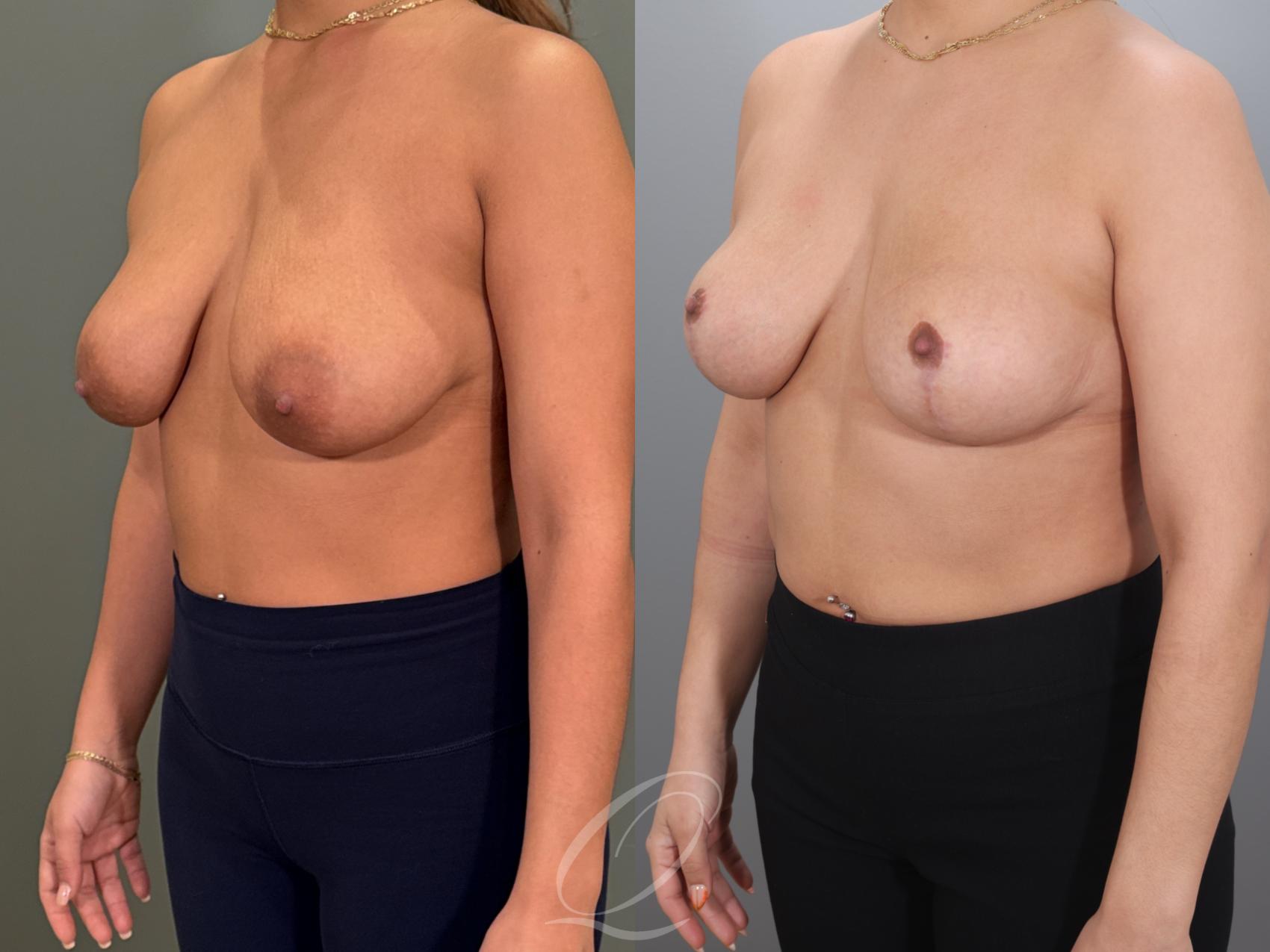 Breast Lift Case 1001980 Before & After Left Oblique | Serving Rochester, Syracuse & Buffalo, NY | Quatela Center for Plastic Surgery