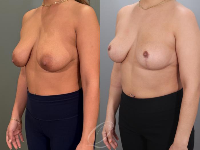Breast Lift Case 1001980 Before & After Left Oblique | Serving Rochester, Syracuse & Buffalo, NY | Quatela Center for Plastic Surgery