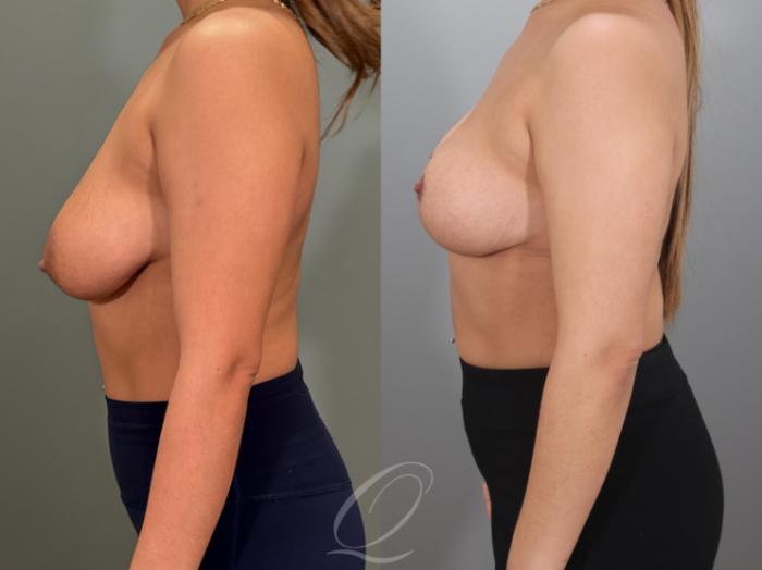 Breast Lift Case 1001980 Before & After Left Side | Serving Rochester, Syracuse & Buffalo, NY | Quatela Center for Plastic Surgery