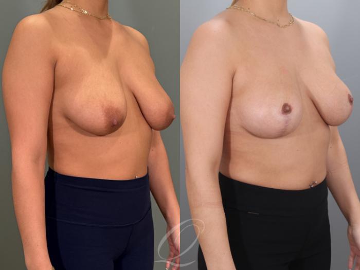 Breast Lift Case 1001980 Before & After Right Oblique | Serving Rochester, Syracuse & Buffalo, NY | Quatela Center for Plastic Surgery