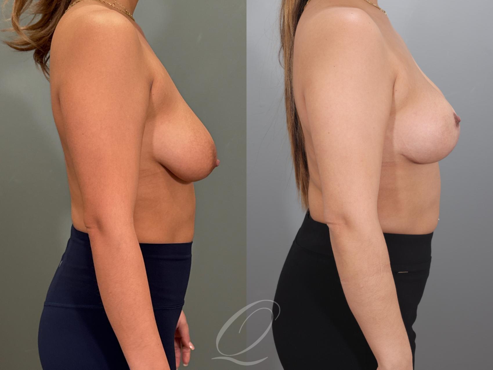 Breast Lift Case 1001980 Before & After Right Side | Serving Rochester, Syracuse & Buffalo, NY | Quatela Center for Plastic Surgery