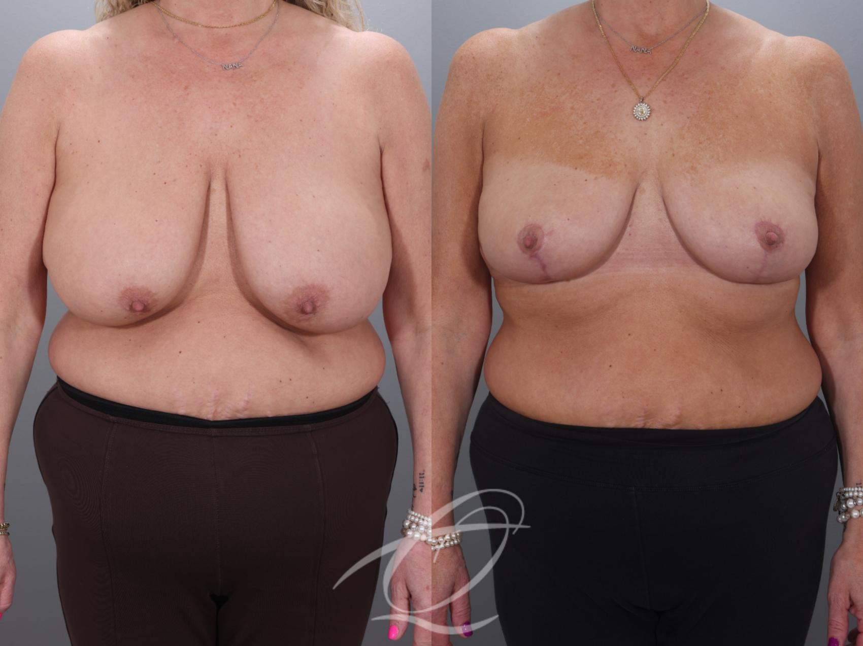 Breast Lift Case 1002018 Before & After Front | Serving Rochester, Syracuse & Buffalo, NY | Quatela Center for Plastic Surgery