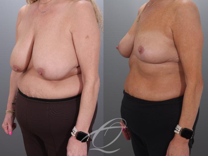 Breast Lift Case 1002018 Before & After Left Oblique | Serving Rochester, Syracuse & Buffalo, NY | Quatela Center for Plastic Surgery
