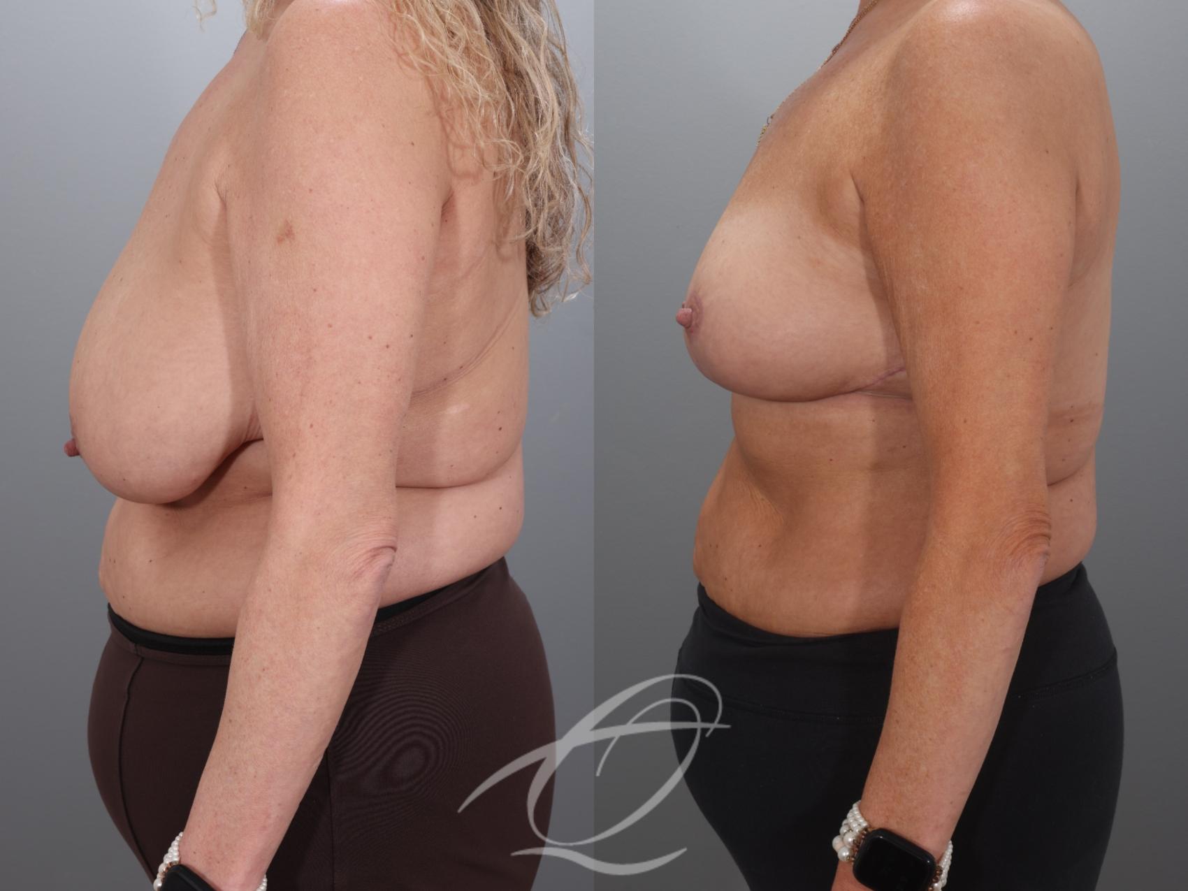 Breast Lift Case 1002018 Before & After Left Side | Serving Rochester, Syracuse & Buffalo, NY | Quatela Center for Plastic Surgery