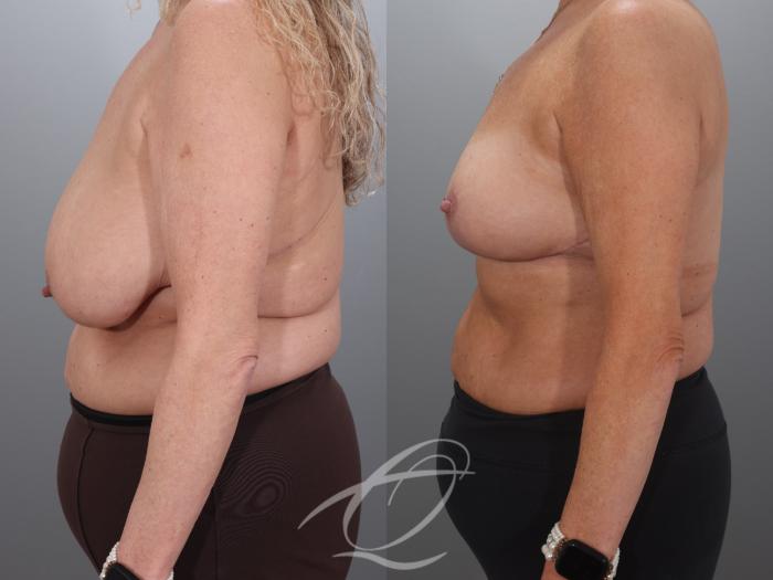Breast Lift Case 1002018 Before & After Left Side | Serving Rochester, Syracuse & Buffalo, NY | Quatela Center for Plastic Surgery