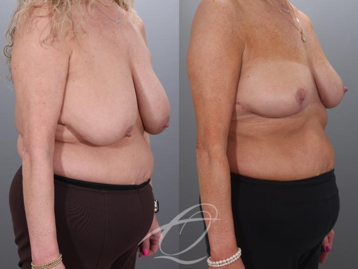 Breast Lift Case 1002018 Before & After Right Oblique | Serving Rochester, Syracuse & Buffalo, NY | Quatela Center for Plastic Surgery