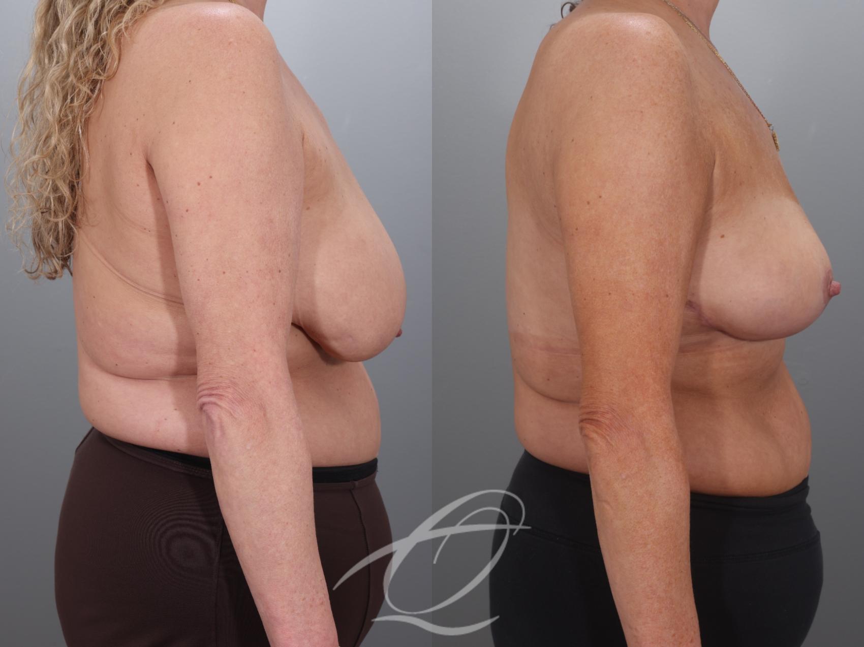 Breast Lift Case 1002018 Before & After Right Side | Serving Rochester, Syracuse & Buffalo, NY | Quatela Center for Plastic Surgery