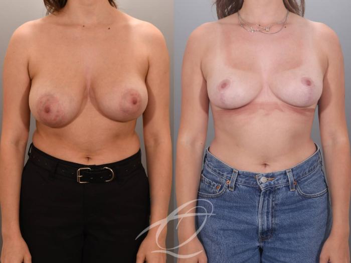 Breast Lift Case 1002059 Before & After Front | Serving Rochester, Syracuse & Buffalo, NY | Quatela Center for Plastic Surgery
