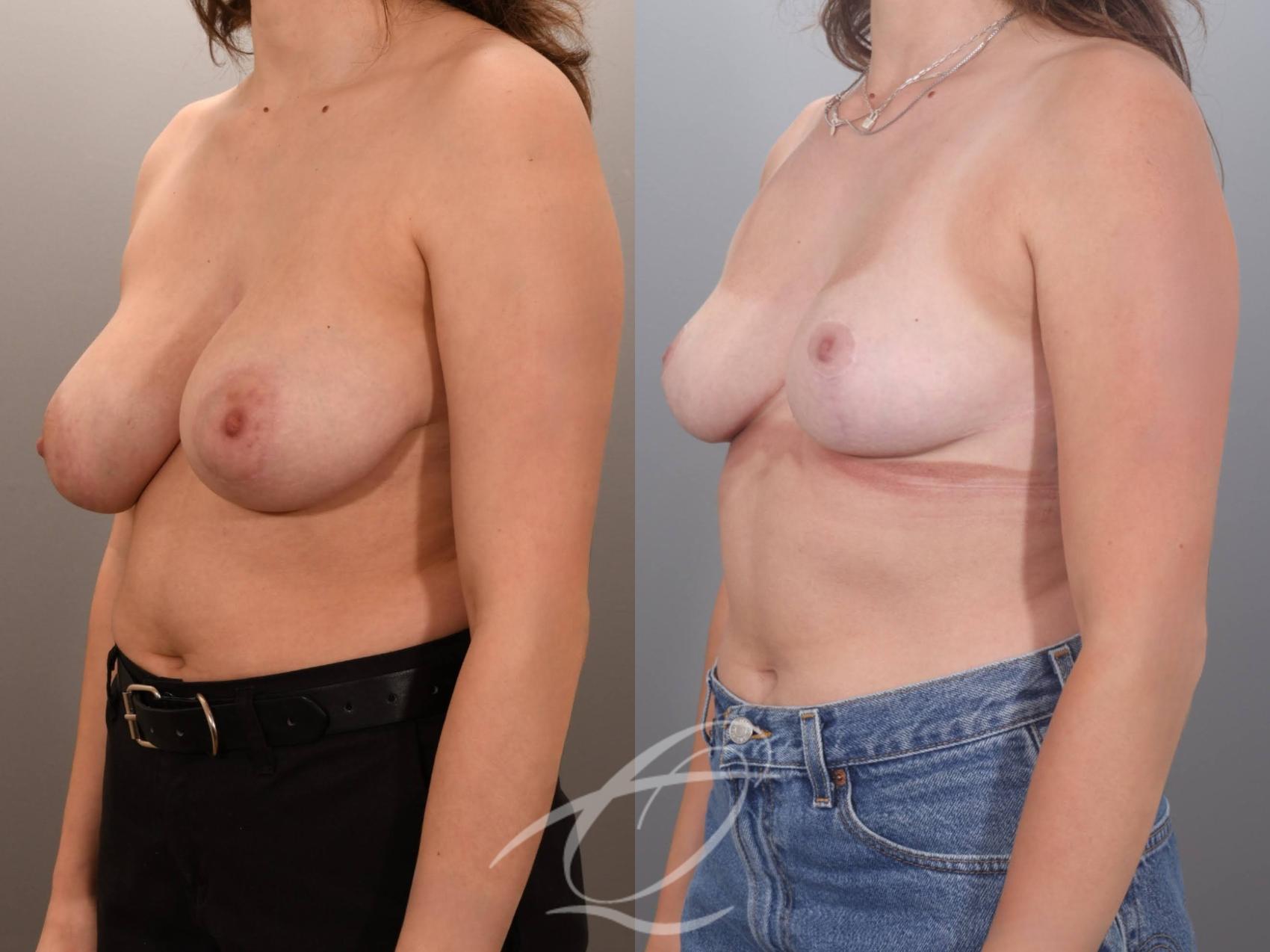 Breast Lift Case 1002059 Before & After Left Oblique | Serving Rochester, Syracuse & Buffalo, NY | Quatela Center for Plastic Surgery