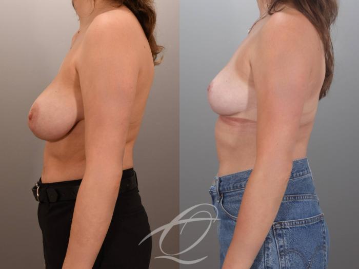 Breast Lift Case 1002059 Before & After Left Side | Serving Rochester, Syracuse & Buffalo, NY | Quatela Center for Plastic Surgery