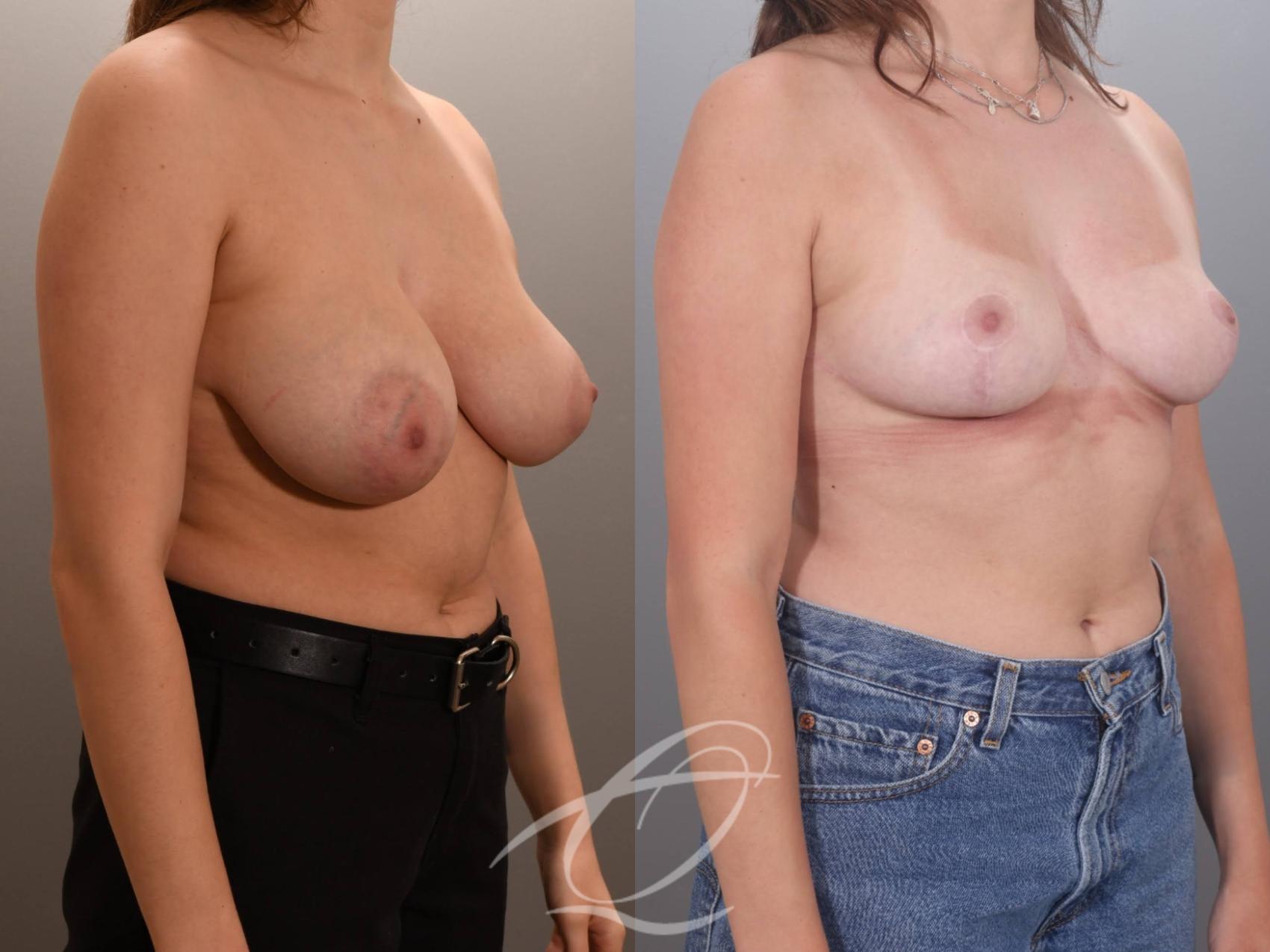 Breast Lift Case 1002059 Before & After Right Oblique | Serving Rochester, Syracuse & Buffalo, NY | Quatela Center for Plastic Surgery
