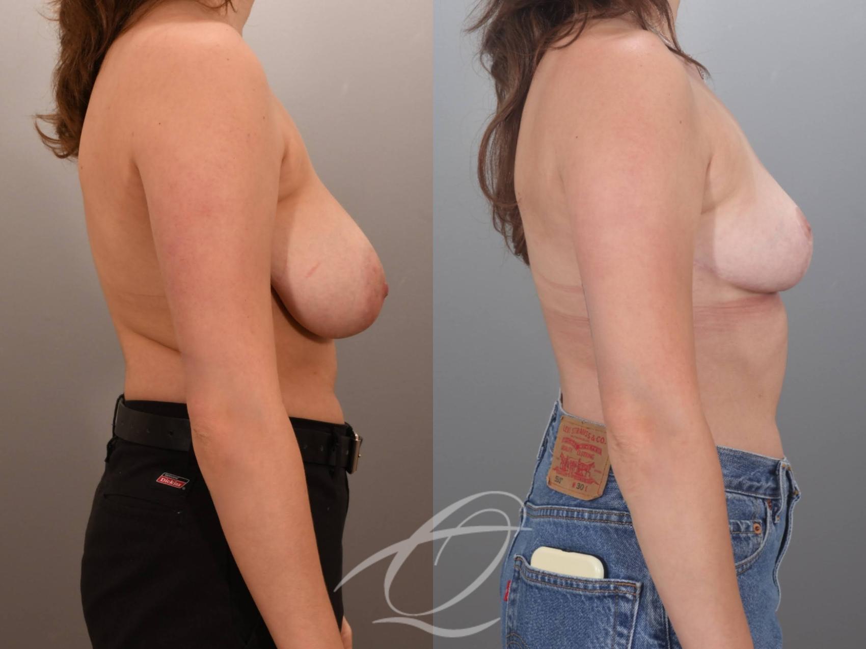 Breast Lift Case 1002059 Before & After Right Side | Serving Rochester, Syracuse & Buffalo, NY | Quatela Center for Plastic Surgery