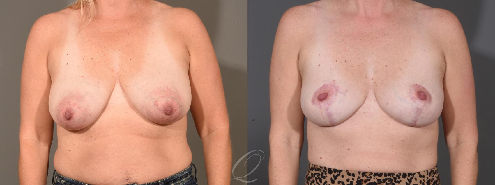 Breast Lift Case 1357 Before & After Front | Serving Rochester, Syracuse & Buffalo, NY | Quatela Center for Plastic Surgery