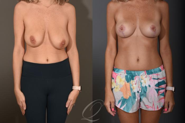 Breast Lift Case 1400 Before & After Front | Serving Rochester, Syracuse & Buffalo, NY | Quatela Center for Plastic Surgery