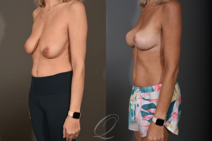 Breast Lift Case 1400 Before & After Left Oblique | Serving Rochester, Syracuse & Buffalo, NY | Quatela Center for Plastic Surgery