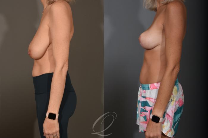 Breast Lift Case 1400 Before & After Left Side | Serving Rochester, Syracuse & Buffalo, NY | Quatela Center for Plastic Surgery