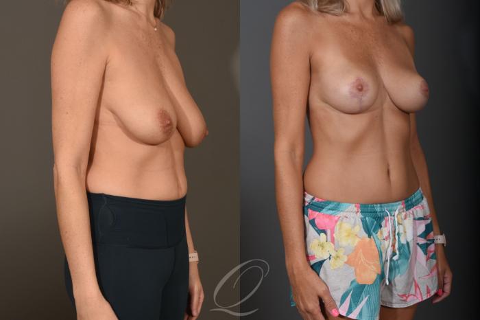Breast Lift Case 1400 Before & After Right Oblique | Serving Rochester, Syracuse & Buffalo, NY | Quatela Center for Plastic Surgery