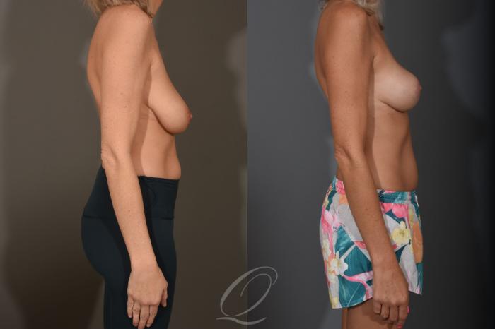 Breast Lift Case 1400 Before & After Right Side | Serving Rochester, Syracuse & Buffalo, NY | Quatela Center for Plastic Surgery