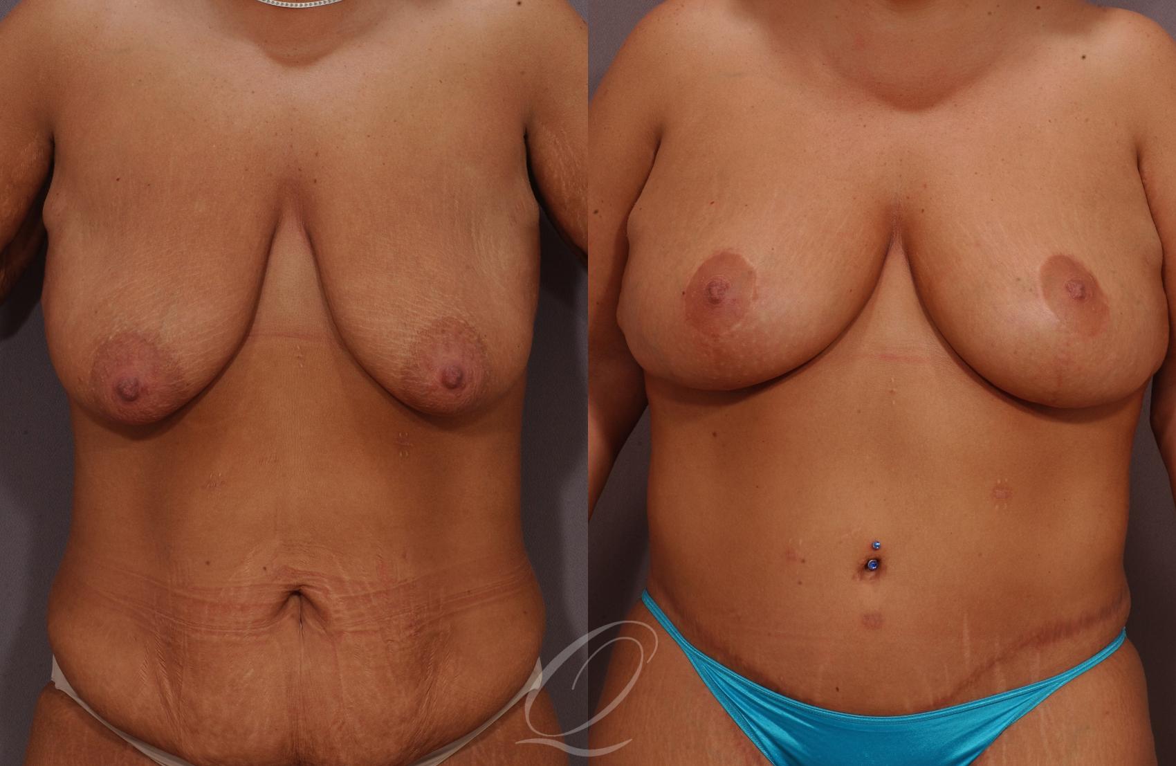 Breast Lift Case 29 Before & After View #1 | Serving Rochester, Syracuse & Buffalo, NY | Quatela Center for Plastic Surgery